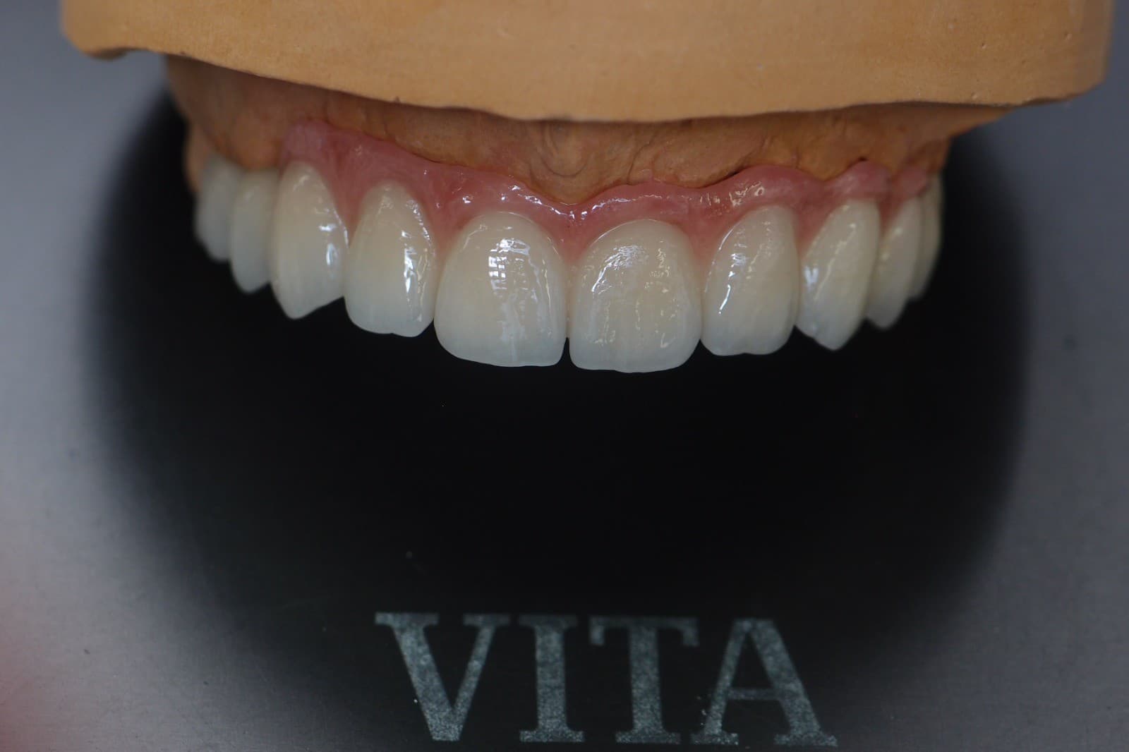 Implantatprothetik – Laboratoire Schaack