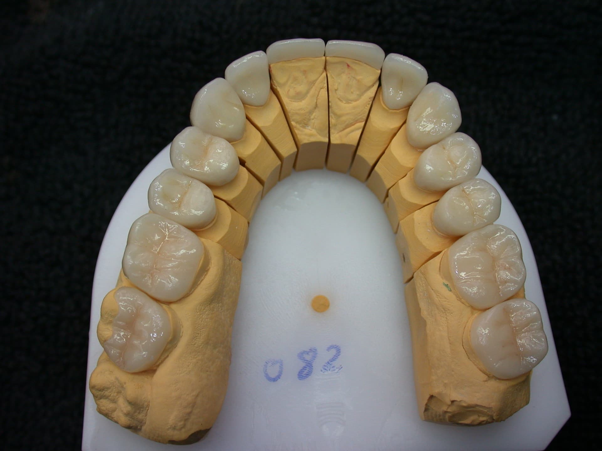 Festsitzender Zahnersatz – Laboratoire Schaack