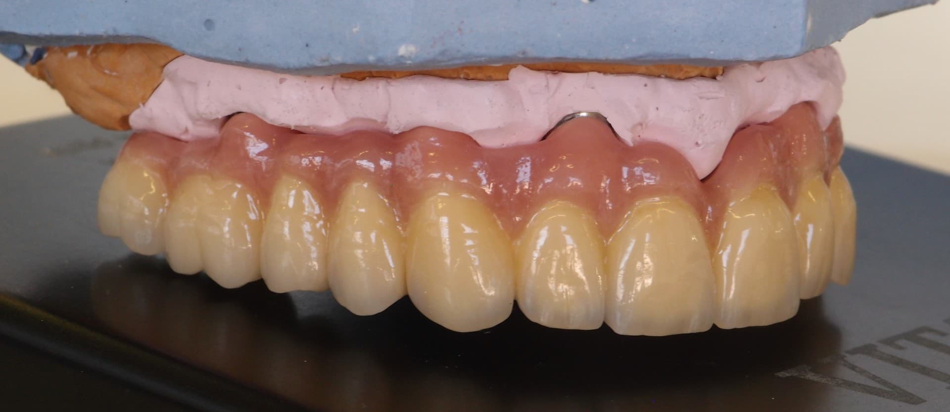 Implantatprothetik – Laboratoire Schaack