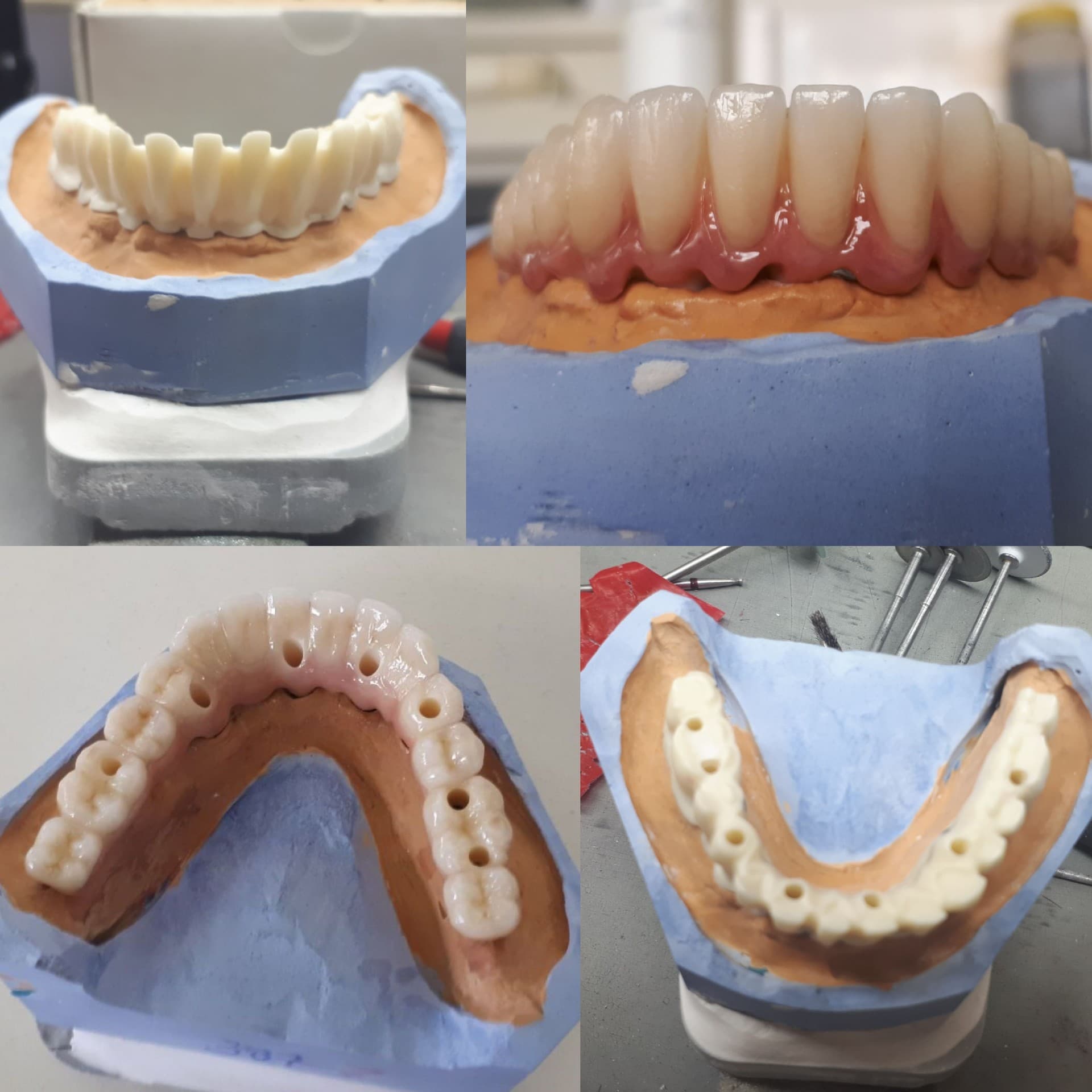 Implantatprothetik – Laboratoire Schaack