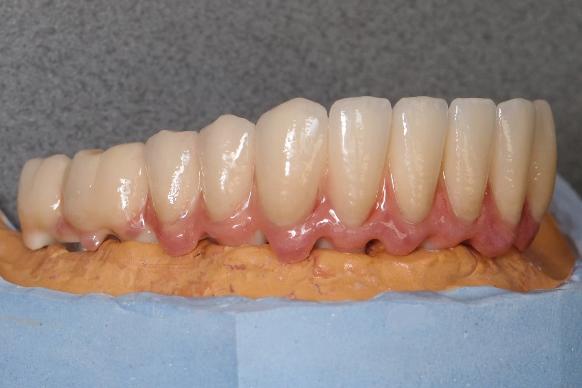 Implantatprothetik – Laboratoire Schaack