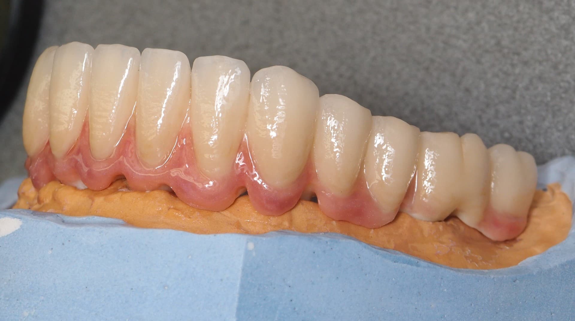 Implantatprothetik – Laboratoire Schaack