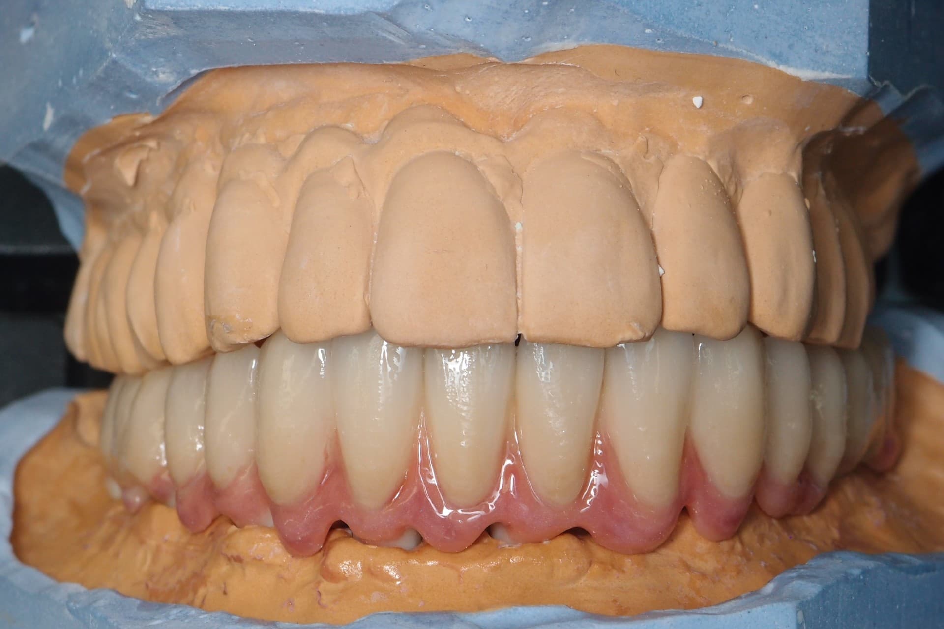Implantatprothetik – Laboratoire Schaack