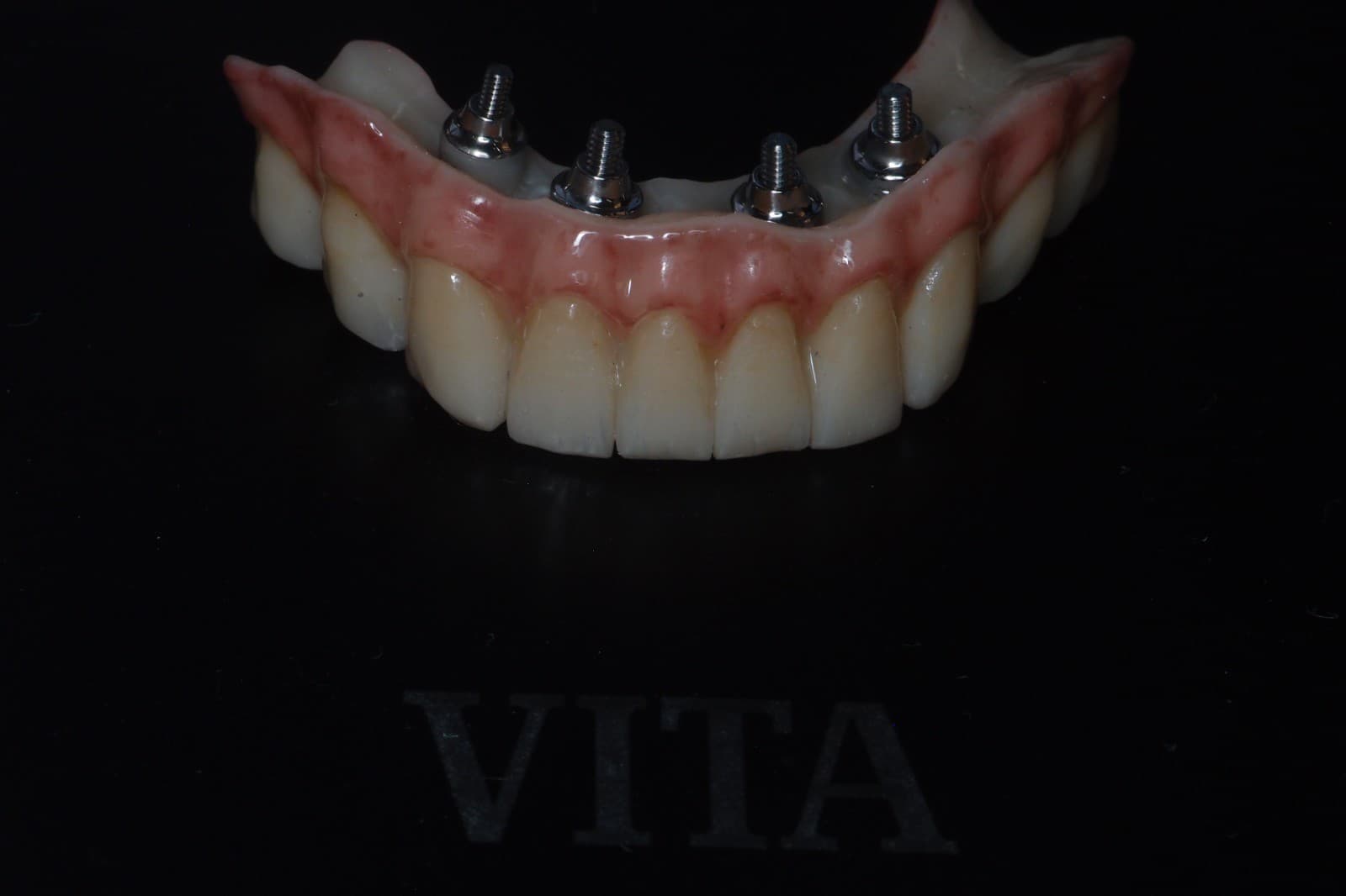 Implantatprothetik – Laboratoire Schaack