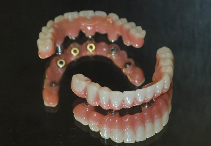 Implantatprothetik